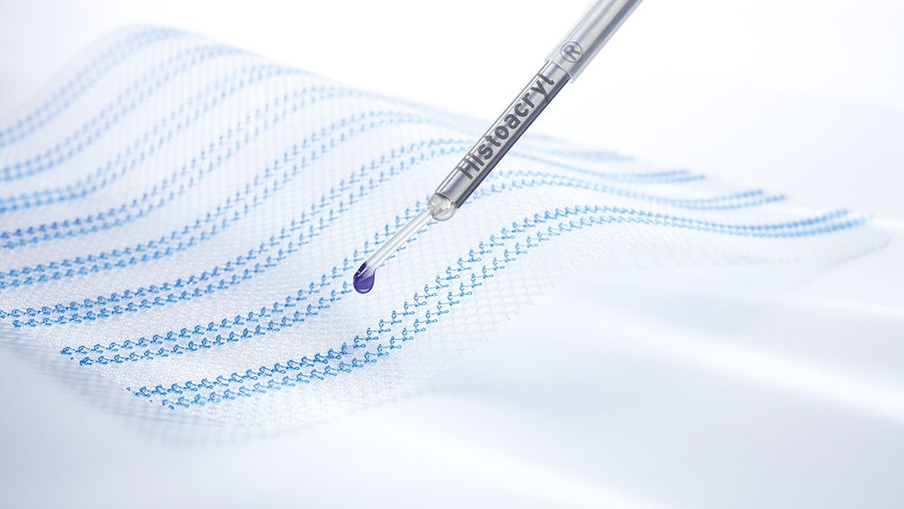 Kirurginen herniaverkko ja Histoacryl® LapFix -asetin verkon kiinnittämiseen