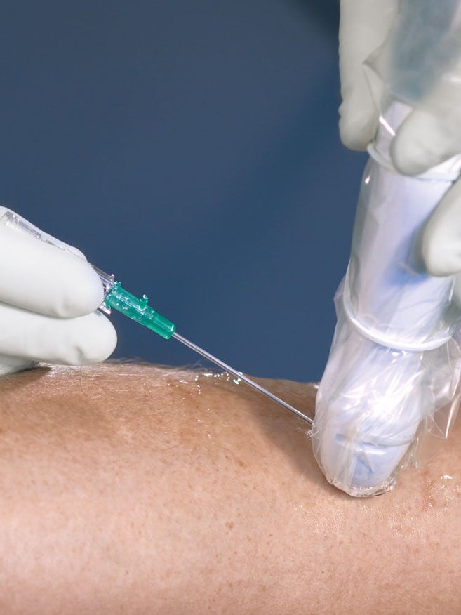 Käsi valkoisessa käsineessä pitää vihreää kanyyliä potilaan käsivarressa, jossa on läpinäkyvää geeliä. Toinen käsi valkoisessa käsineessä pitää ultraäänianturia, jonka läpinäkyvä suojakuori on kiinnitetty valkoisella kuminauhalla.