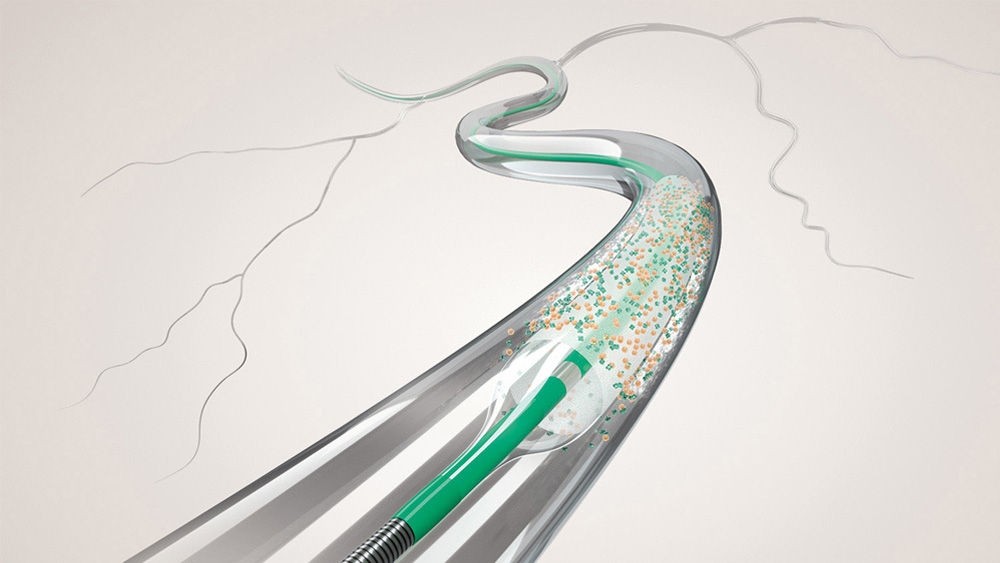 Lääkepäällysteinen sepelvaltimopallo, jota käytetään kalkkiutuneen sepelvaltimoleesion angioplastiassa.